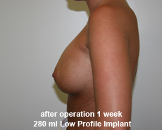 plastic-surgery-breast-augmentation